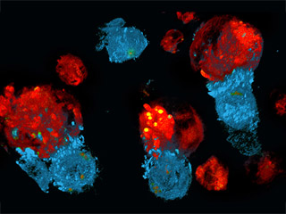wizualizacja komórek chłoniaka